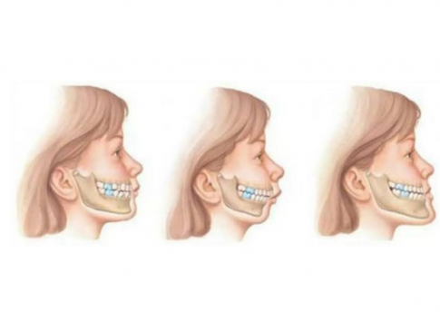 Maloklusi: Pengertian, Jenis, dan Penanganan